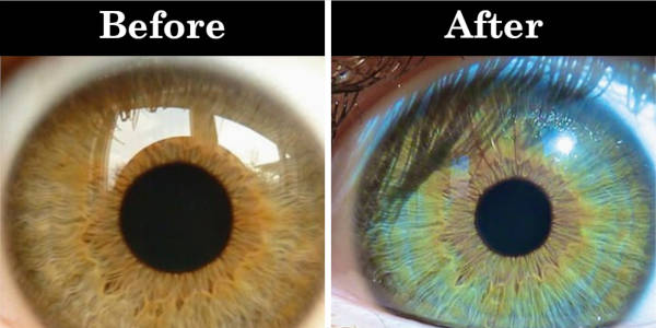 change eye color surgery iran,