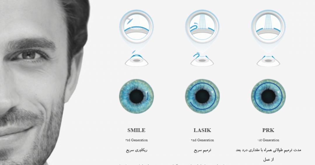 علاج ضعف النظر و تصحيح النظر عمليه فيمتو سمايل