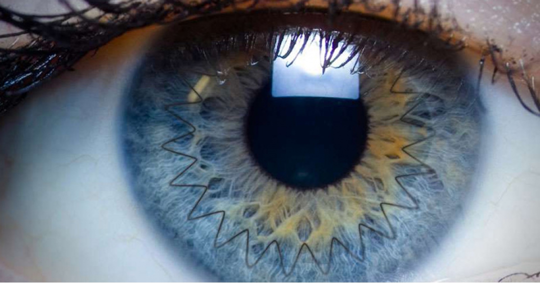 جراحة زراعة القرنية في مستشفيات ايران