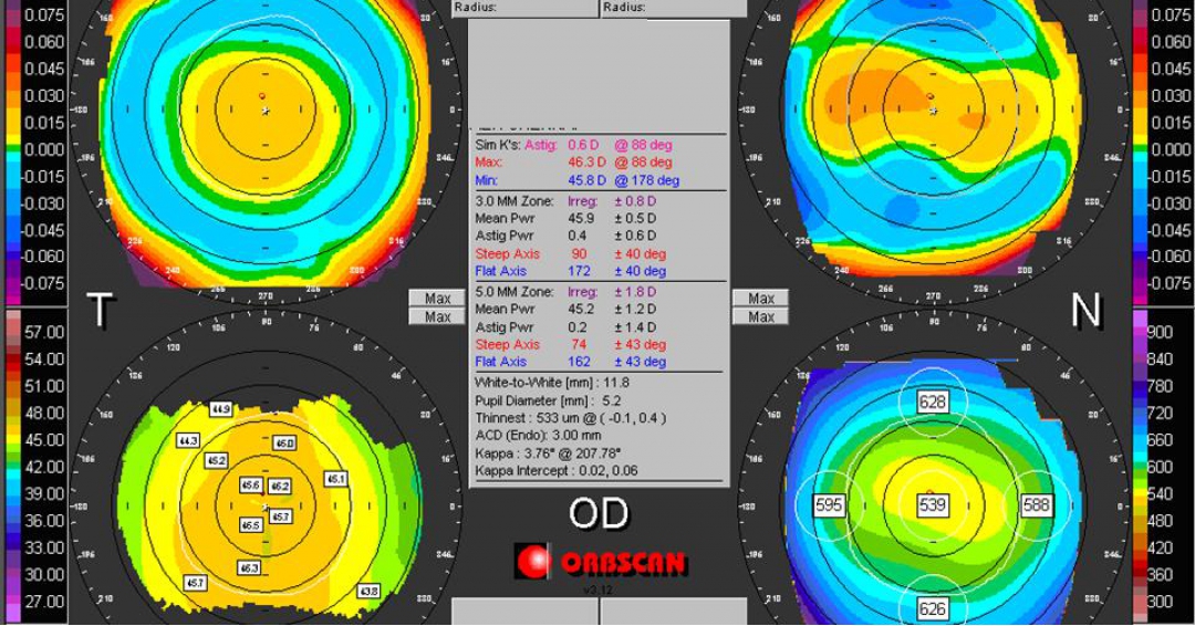 جهاز اختبار فحص قرنية العين اورب سكن orbscan