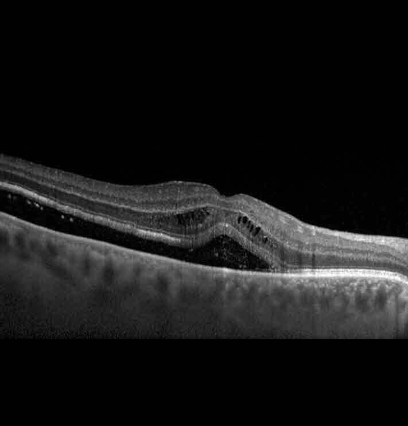 أمراض الشبكية