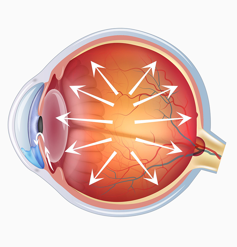 الجلوكوما | الغلوكوما | المياه الزرقاء | الزرق | الماء الاسود في العين Glaucoma