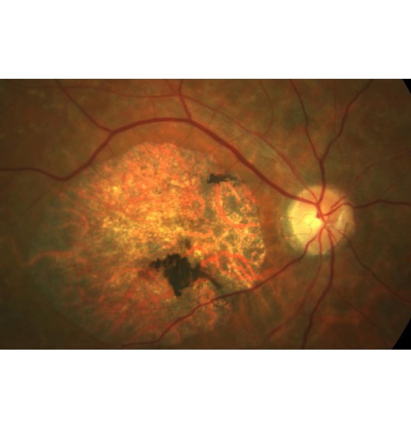 ما هو مرض ستارغاردت؟